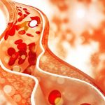 high cholesterol treatment in dubai